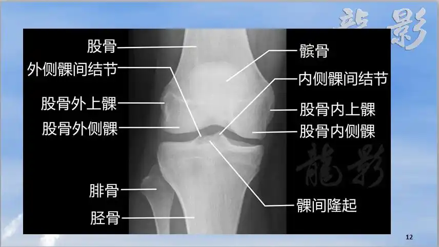 跑步者膝关节外侧疼痛——髂胫束摩擦综合症影像学表现