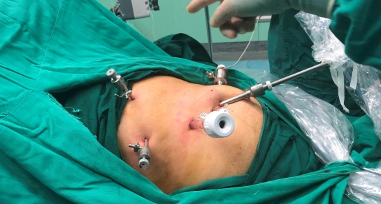 偷偷告诉你,腹腔镜下食管裂孔疝修补术 胃底折叠术属于微创手术,伤口