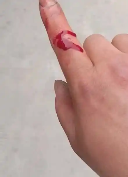 不小心把手划破了.