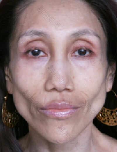 眼睛凹陷手术多少钱日本takami整形医院玻尿酸填充眼窝经历分享