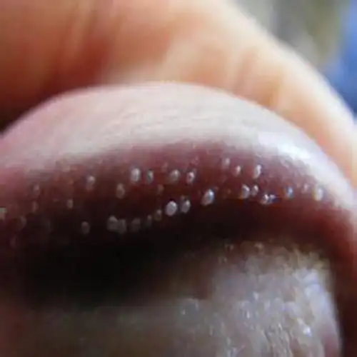 手臂起红色丘疹图片