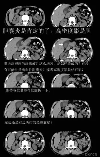 【请教】胆囊内高密度影是高密度渗出液还是胆囊结石?