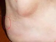 病因:跟腱止.[详细]