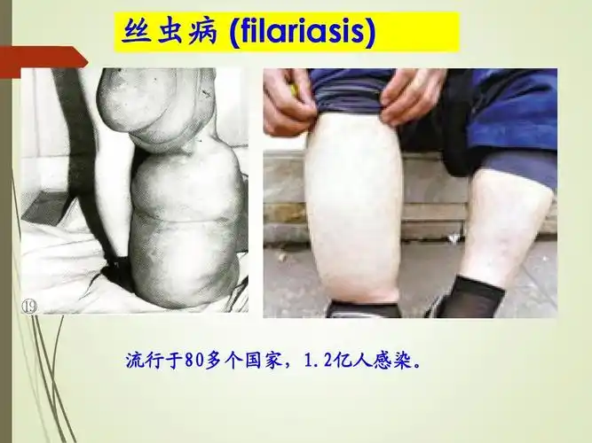 丝虫病 (filariasis) 流行于80多个国家,1.2亿人感染.