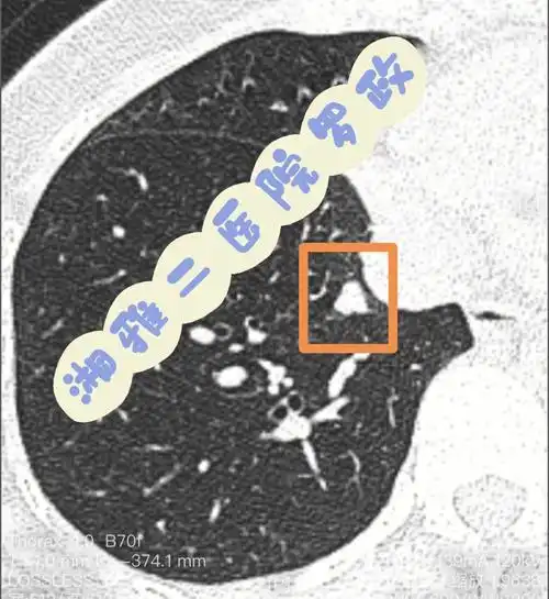 1cm经我影像诊断有最后手术病理的肺结节