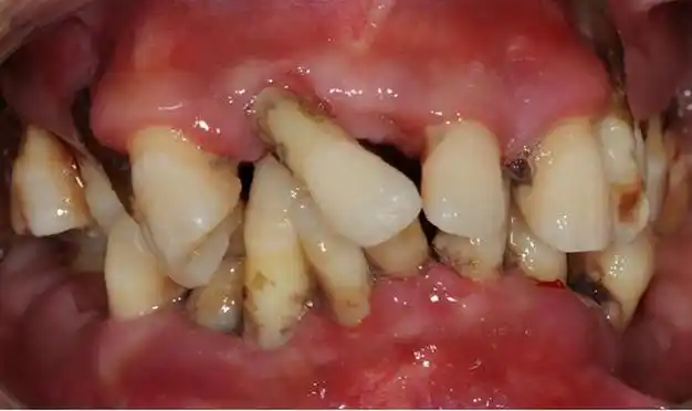 关注牙龈出血和牙齿松动,预防牙周疾病|炎症|牙龈炎|牙周炎|口腔疾病