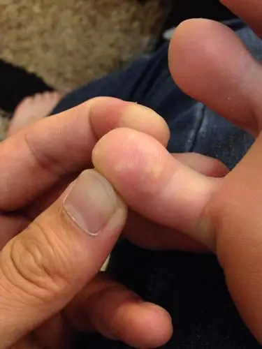 右脚小趾头长了几个黄色包,很长时间了,不