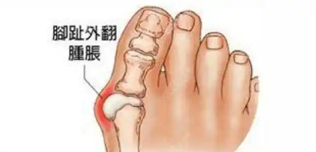 北京正规大脚骨医院圣嘉新看的如何?