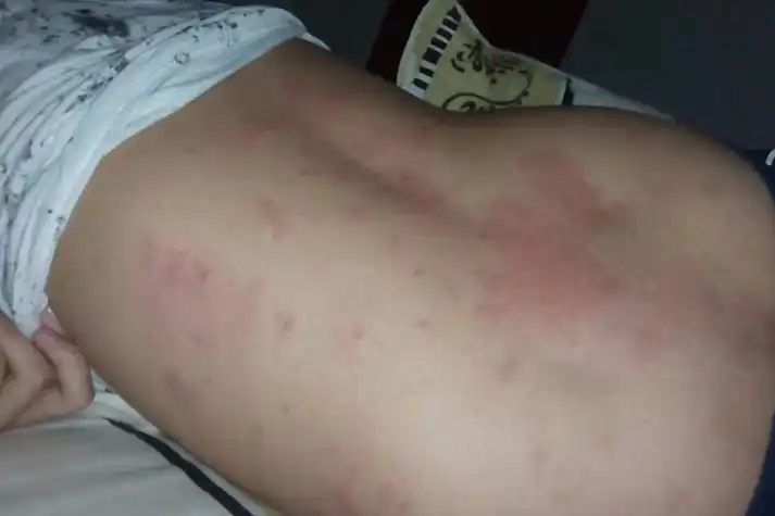 润滑油过敏红肿图片_有来医生