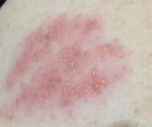 全部答案(共 3个回答) 2018-11-13 12:18:57 荨麻疹俗称风团,是一种