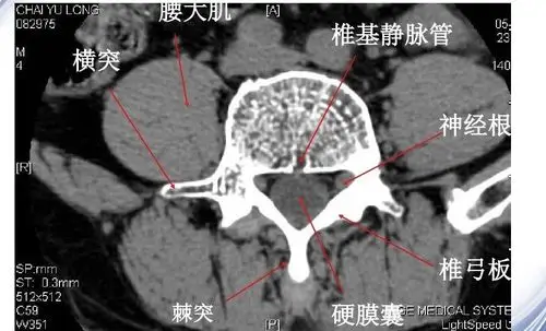 腰椎影像解剖及常见病变