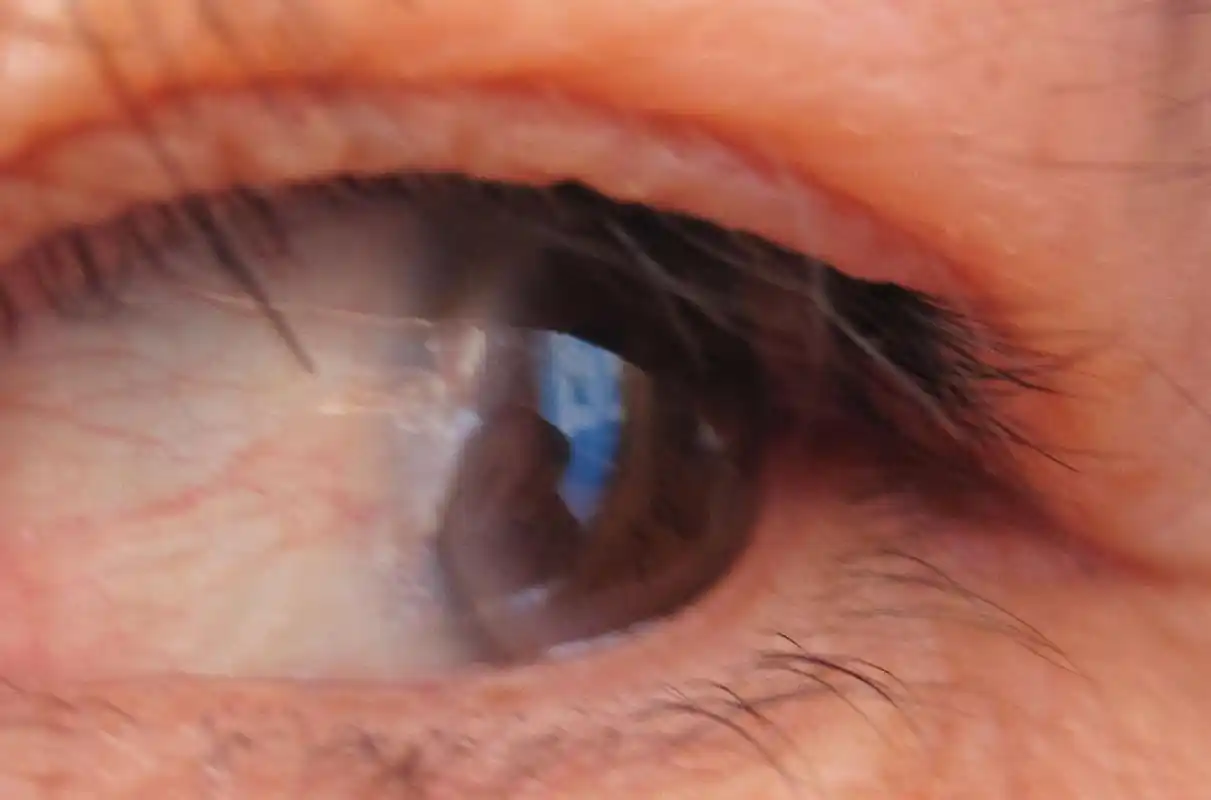 左眼睛的瞳孔一圈有黑白浑浊倾向,其中右上角出现白色斑块向瞳孔靠近