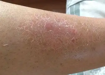 初期银屑病图片及症状