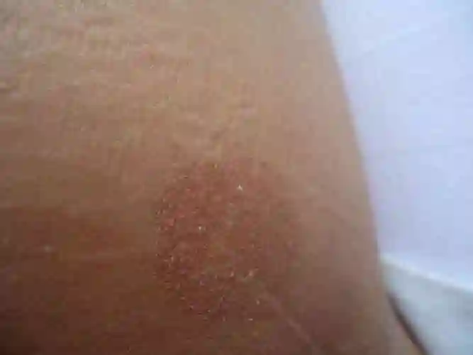 有儿童常见各种癣的图片介绍吗