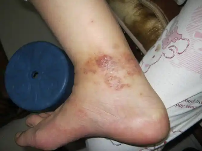 脚上起水泡,医生说是真菌感染,医生说孕妇不能涂药膏,怎么办