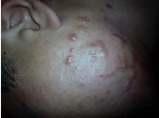 各位朋友,看看我脸上的这个痘痘囊肿,结节,怎么才能根治,我需要你们的