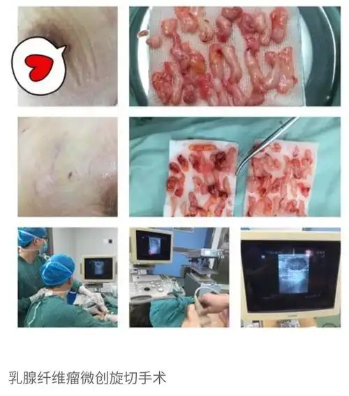 乳腺肿块(乳腺纤维腺瘤)如何治疗?如何选择手术方式?