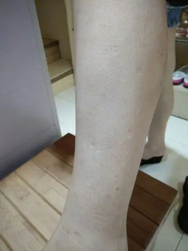 最近小腿上会出现一些白色小斑点,不知是什么问题?请大神指点.