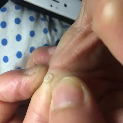 手上长了一个类似茧的东西,仔细看很多小孔孔一样的,硬硬的.