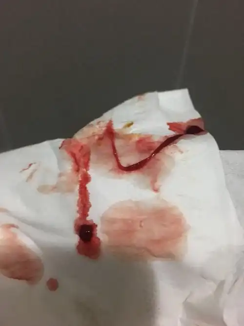 最近大便会滴血而且时间挺长了第一次不确定是不是痔疮便