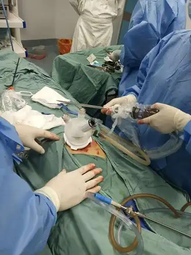 周浦医院妇产科柳洲主任单孔腹腔镜输卵管切除术