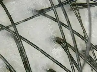 一个毛囊里多少头发才是正常的