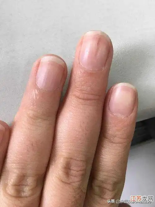 手指甲上有竖条纹是怎么回事-,手指甲上出现竖条纹是什么症状