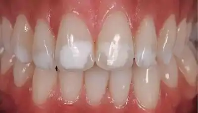 轻,中,重度氟斑牙-icon渗透治疗 科贸嘉友收录