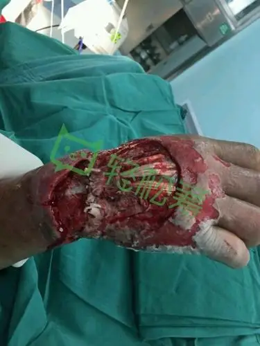 2008年在湘雅附二医院做了心脏搭桥术,因心脏问题严重,影响伤口愈合