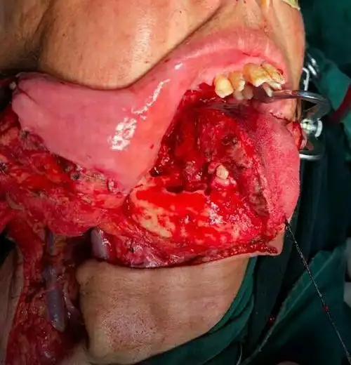 舌癌根治术同期行前臂皮瓣舌再造