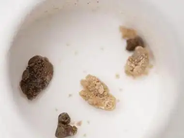 肾结石尿结石怎么治疗