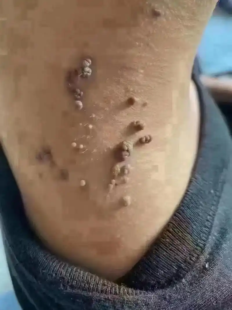 身体上长疣的人 一定要重视 hpv病毒感染皮肤 各种疣瘊都是 - 抖音