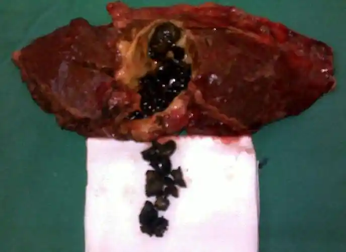 肝内外胆管结石 - 好大夫在线