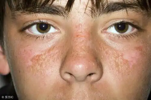 女人色素沉着,多吃这1物,清除黑色素,到老也不长斑