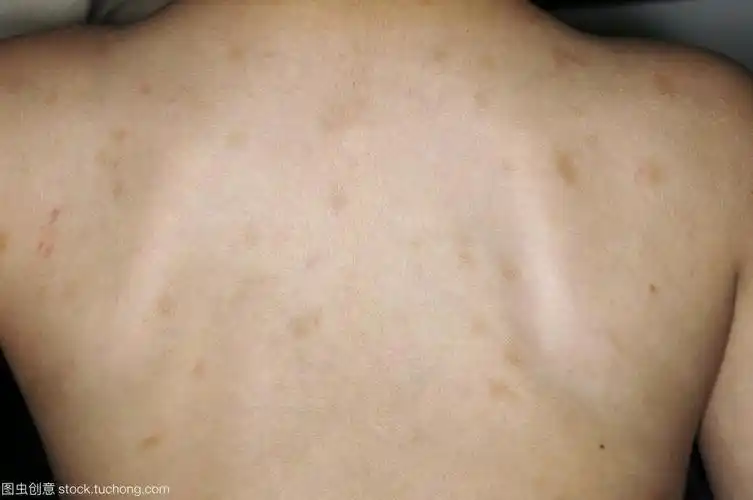 神经纤维瘤病的遗传_神经纤维瘤病_遗传_介绍 - 好大夫在线