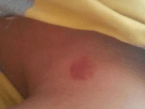 脖子上的吻痕怎么快速消除?五大方法让你三分钟去除