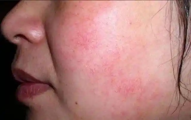 为什么会毛细血管扩张 为什么会毛细血管扩张的原因