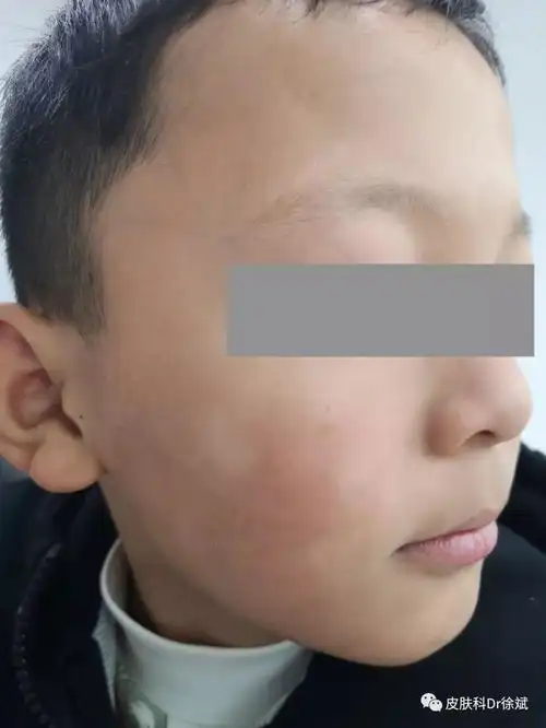 临床最常见的儿童面部白斑,具体病因不明,可能与过敏体质,维生素缺乏