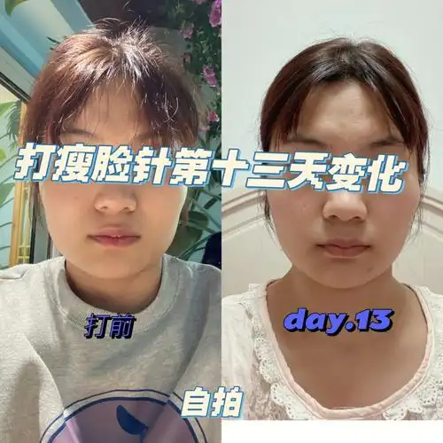打瘦脸针第十三天变化