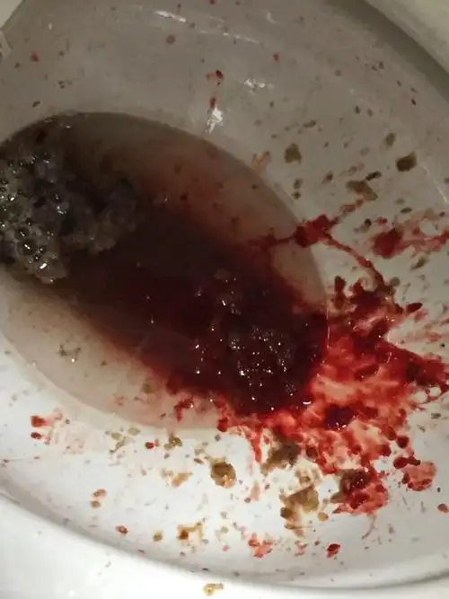 平时也有呕吐反应,但今天晚上呕吐了很多的血水,刚开始呕吐的是