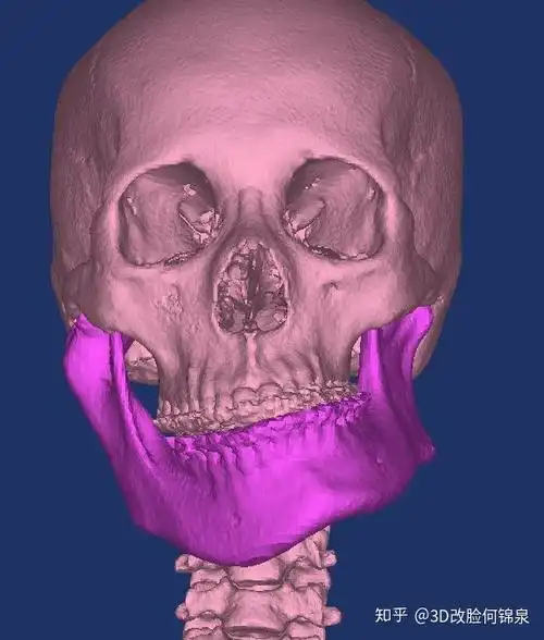 面部严重不对称畸形