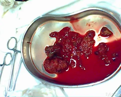 胆囊颈部大结石肝内外胆管多发结石伴胆管扩张明显