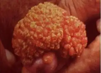 菜花状湿疣图片什么样.20