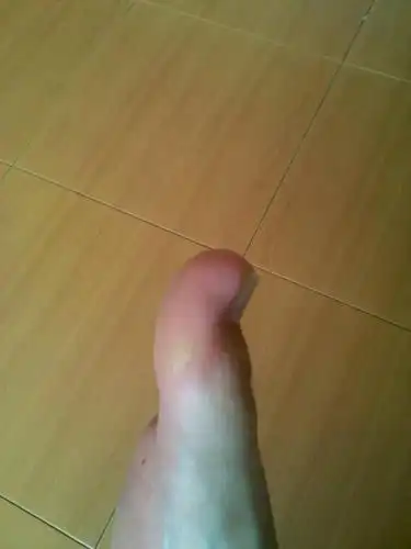 脚趾甲上翘是怎么回事?