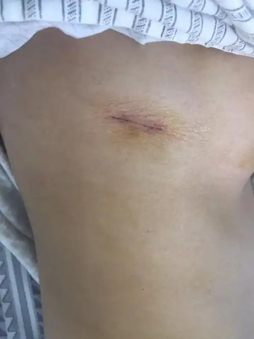 目前肺癌最微创的3cm单切口,我院目前开展的肺癌手术多数采用此切口再