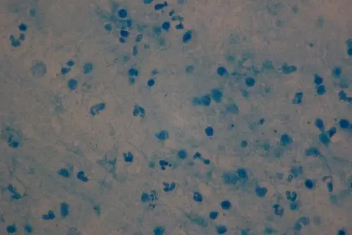 颈部肿物抗酸染色(油镜)