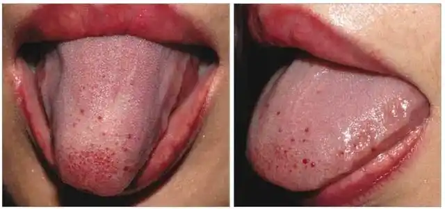 偏瘫患者的舌部红疹