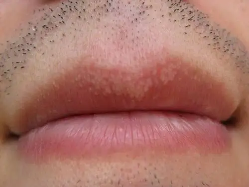 嘴唇上生了许多白点,不疼不痒,几年了,远看就像白斑,是啥病啊?