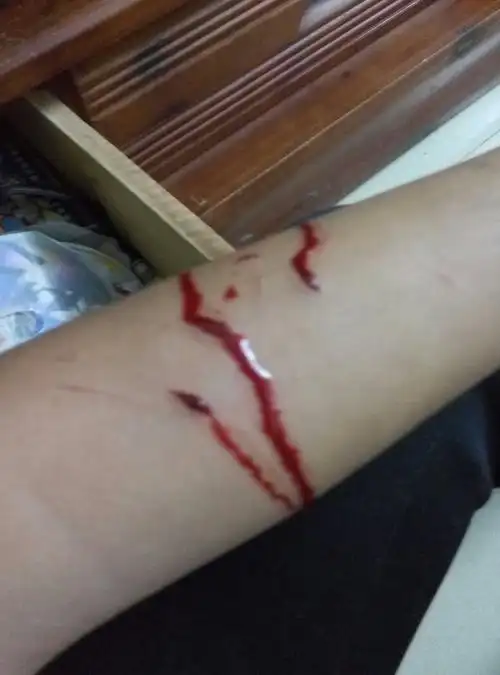 前天的弄的伤,当时只贴了可创可贴,流了挺多血(第二张).