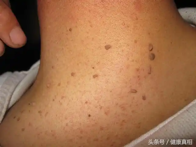 1,软纤维瘤:也叫皮赘,除了常见的颈部,腋下,腹股沟也是好发部位.